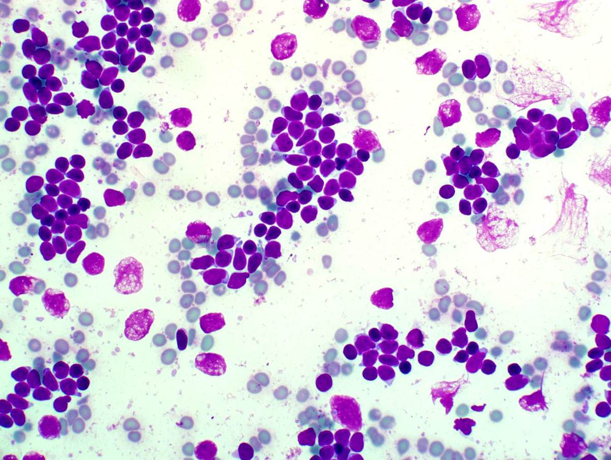 Fine needle aspiration of mediastinal mass showed numerous immature lymphoid cells